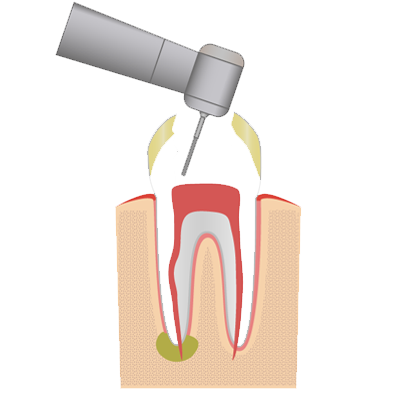 Endodoncia