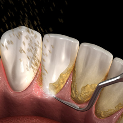 Profilaxis, Limpieza Dental