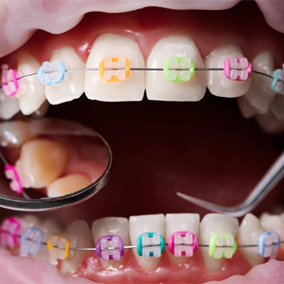 Ortodoncia, Brackets, Frenos